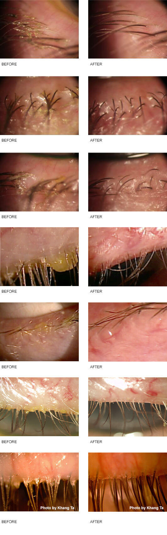 Blepharitis Before and After