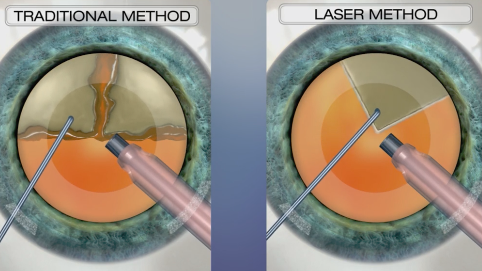 cataract-treatment-options-lasik-cataract-centre